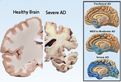 Healthy Brain and Alzheimers Brain Alzheimer's Disease Affects Brain Stages