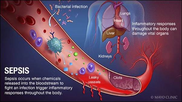 Many coronavirus patients have died of sepsis — when the body's ...