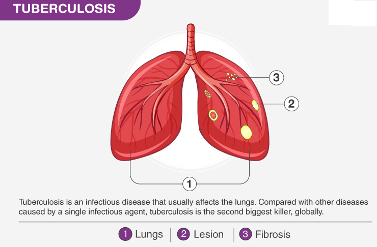 TUBERCULOSIS 
3 
2 
Tuberculosis is an infectious disease that usually affects the lungs. Compared with other diseases 
caused by a single infectious agent, tuberculosis is the second biggest killer, globally. 
O Lungs Lesion Fibrosis 