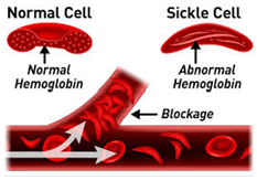 Normal Celt 
Sickle cell 
Hemoglobin 
Bio-eage 