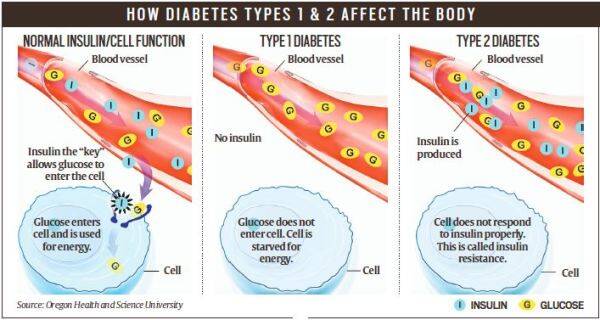 What Is Type 1 Diabetes?